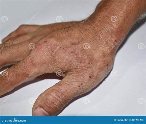 Tinea Manus or Fungal Infection on Hand of Southeast Asian, Burmese ...