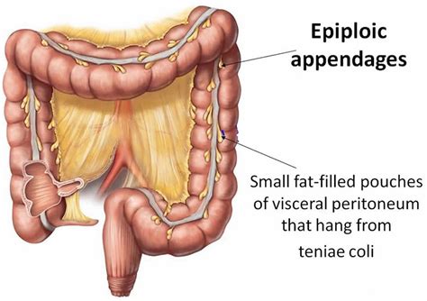 Epiploic Appendagitis Causes Symptoms Diagnosis Treatment