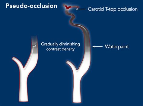 The Radiology Assistant How To Differentiate Carotid Obstructions