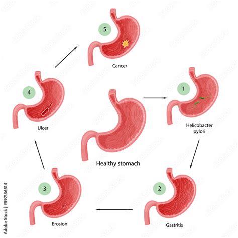 Stomach Diseases Diagram Of Diseases Of Helicobacter Pylori Gastritis Erosion Ulcer And