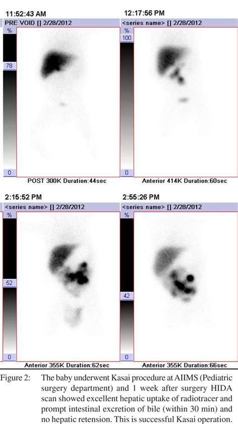 Utility Of 99mtc Mebrofenin Hepato Biliary Scintigraphy Hida Scan For