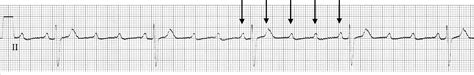 Second Degree Heart Block Ekg