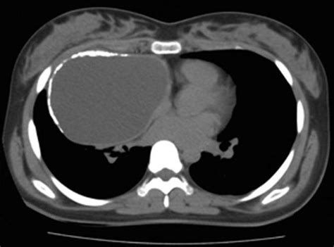 Mediastinal Ct Images Of Cysts