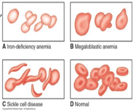 Ms Hematology Flashcards Quizlet