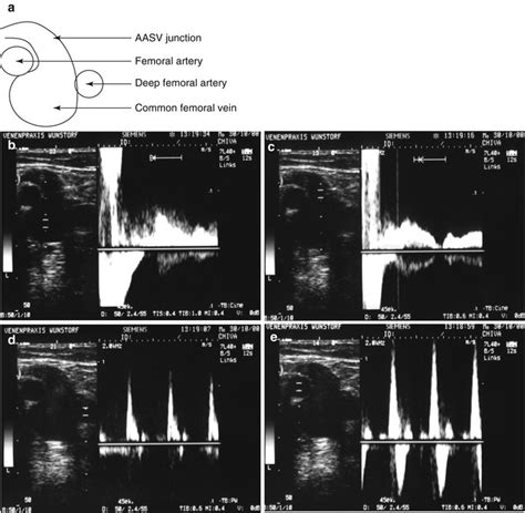 Examination of the Great Saphenous Vein | Radiology Key