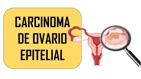 Cáncer De Ovario Ayde Moreno Udocz