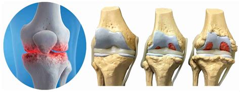 Artrite E Artrose No Joelho Clínica Do Joelho