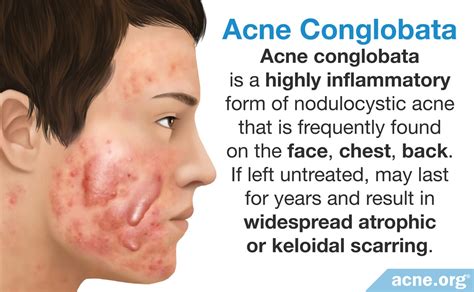 What Is Cystic Acne