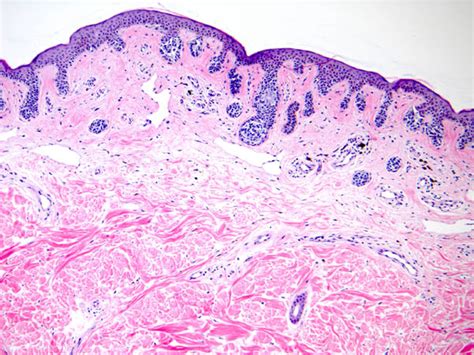 Compound Nevus With Mild Atypia