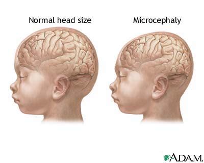 About - Cri du chat syndrome