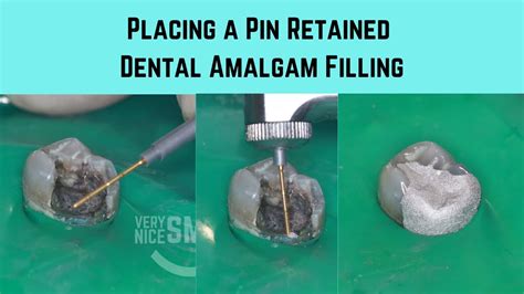 Placing A Pin Retained Dental Amalgam Filling YouTube