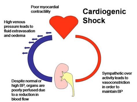 Daily Nursing Trivia N Trivia Cardiogenic Shock Nurse Quotes