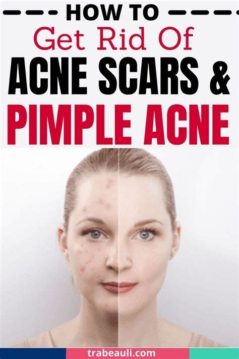 How To Get Rid Of Acne Scars Artofit