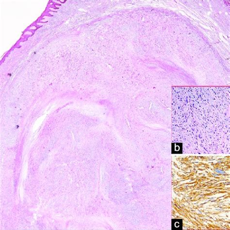 A The Cutaneous Neoplasm Displays A Nodular Growth Pattern H And E Download Scientific