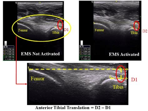 Measurement Of The Anterior Tibial Translation Using Ultrasound Imaging