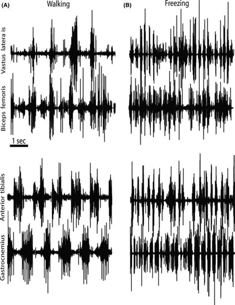 A New Phenotype Of Choreic Syndrome Associating Severe Freezing Of Gait