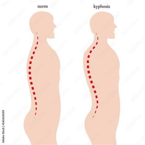 Schematic representation of kyphosis, curvature of the spine. Vector ...