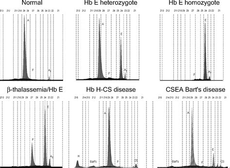 Rapid Diagnosis Of Thalassemias And Other Hemoglobinopathies By