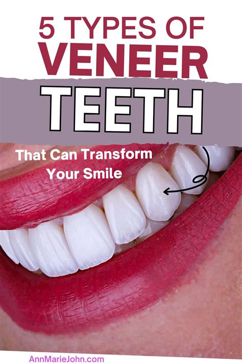 5 Types of Veneer Teeth That Can Transform Your Smile - AnnMarie John