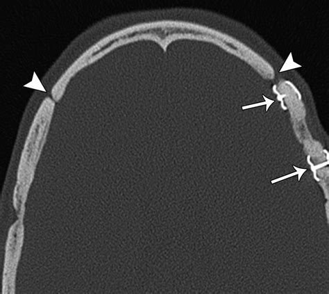 Imaging Of The Post Operative Cranium Radiographics