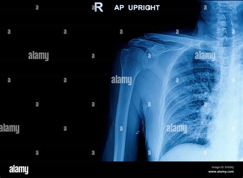 Schulter ct Fotos und Bildmaterial in hoher Auflösung Alamy