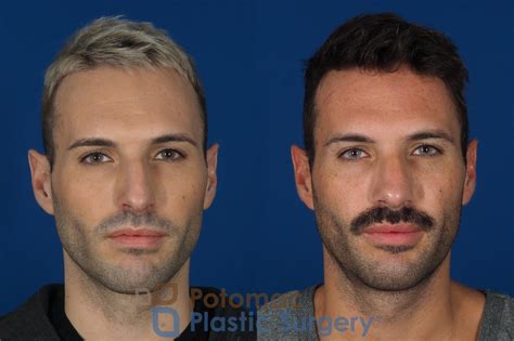 Preservation Septorhinoplasty To Correct A Deviated Septum And Nasal