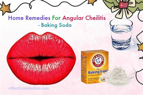 20 Home Remedies For Angular Cheilitis Cracks In Mouth Corners