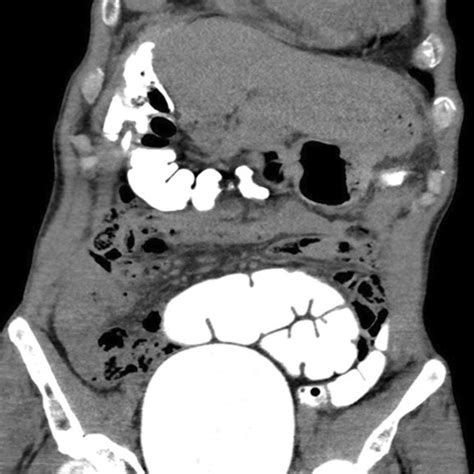 Computed Tomography CT Image Confirming A Colopleural Fistula With