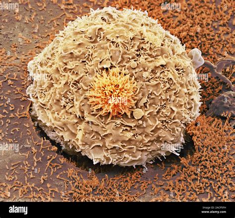 Colorectal Cancer Cell Coloured Scanning Electron Micrograph Sem Of