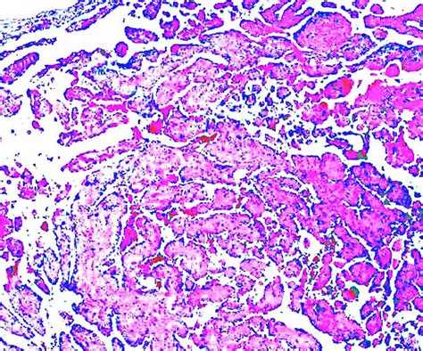 Pathology Outlines Papillary Endothelial Hyperplasia