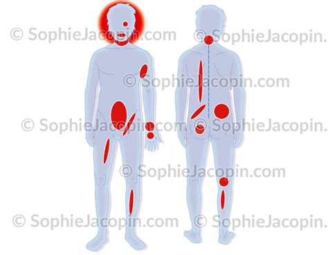 Localisation Des H Matomes Dangereux Illustration Medicale