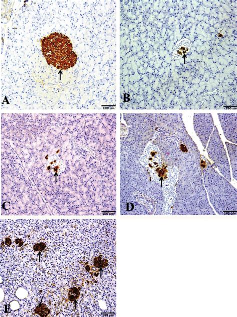 Photomicrographs Of Insulin Immunohistochemical Staining Of Pancreatic