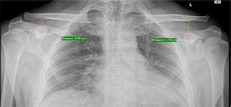 Plain AP Radiograph Stress View Of Both Shoulders Shows Increased CCD