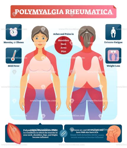 A3 Exam 4 CH 34 1085 1089 Polymyalgia Rheumatica And Giant Cell