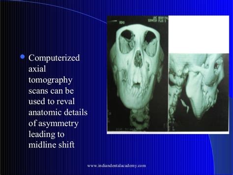 Midline Shift Certified Fixed Orthodontic Courses By Indian Dental A