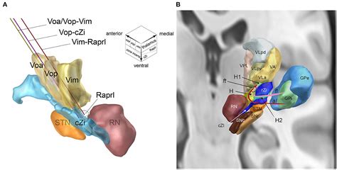 Frontiers A Single Dbs Lead To Stimulate The Thalamus And Subthalamus