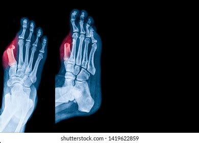 Icd Code For Surgical Wound Amputation Of Toe