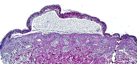 Toxic Epidermal Necrolysis Image Eurekalert Science News Releases