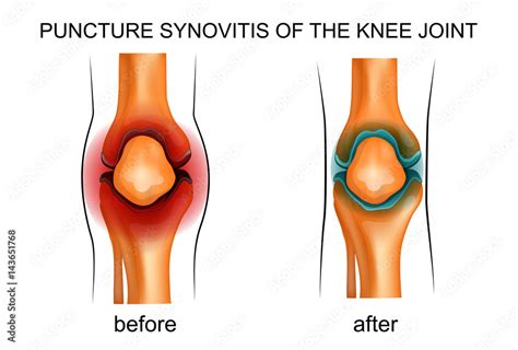 Puncture Synovitis Of The Knee Joint Stock Vector Adobe Stock