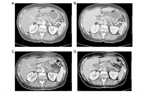 Computed Tomography Ct Scan Before And After The Radiofrequency Download Scientific Diagram