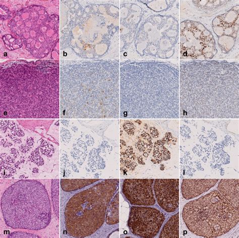 A Morphological And Immunohistochemical Study Of Ductal Carcinoma In