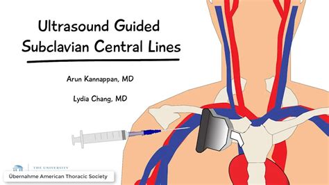 Subclavian Vein Central Line Anatomy