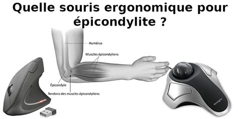 Quelle souris ergonomique pour épicondylite