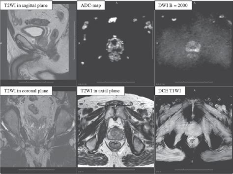 Figure 1 From Biparametric Versus Multiparametric Mri In The Diagnosis Of Prostate Cancer