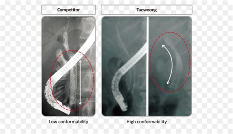 Stenting Biliary Png Png Stenting