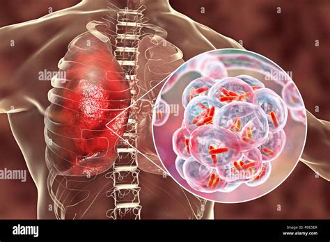 Bacterial Pneumonia Computer Illustration Of Rod Shaped Bacteria