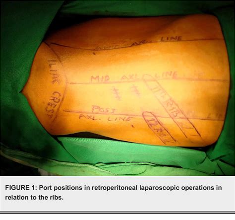 Figure 1 From Combined Retroperitoneal And Transperitoneal Laparoscopic