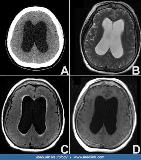 Normal Pressure Hydrocephalus Nph Medlink Neurology