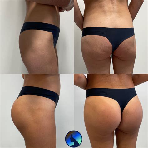 Gluteal Implants Dominik Boliglowa