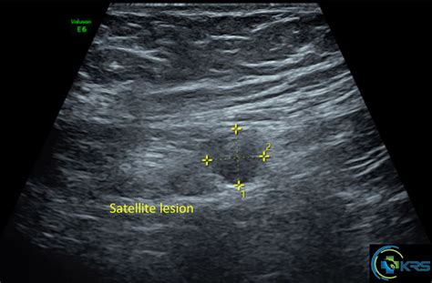 Scar endometriosis - drkalirajanscans